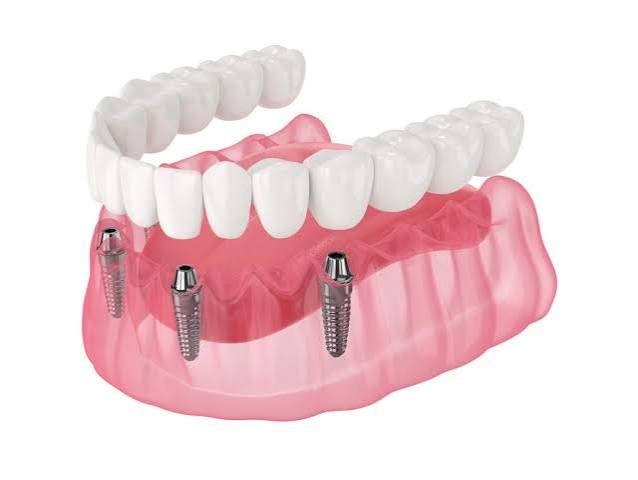 All-on-4 Implants